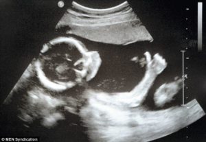 abortion ultrasound scan