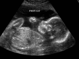 abortion - ultra sound 30 weeks