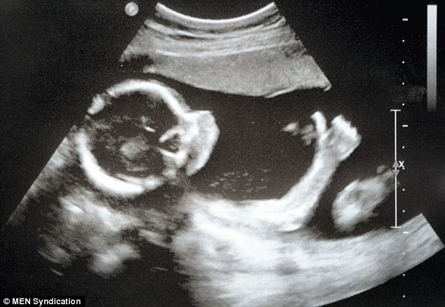 4D ultrasound shows what smoking does to an unborn baby